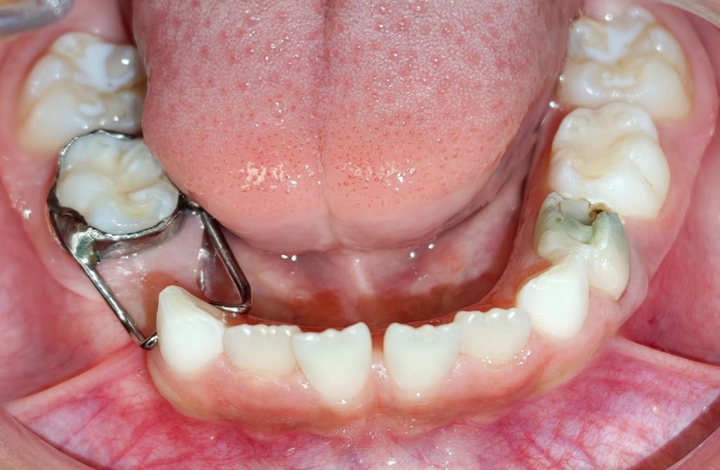 mantenedor de espacio dental